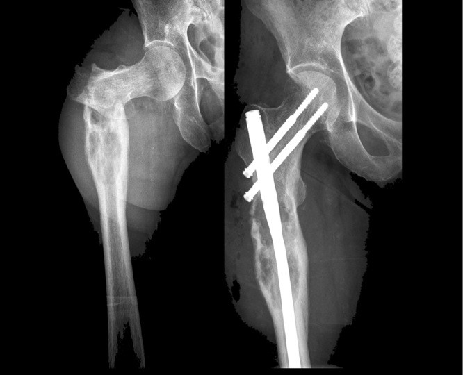 Operationen Von Knochenmetastasen Zentrum Fur Chirurgische