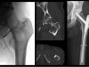 51 jähriger Patient mit Nierenzellkarzinom. Bei stabilitätsgefärhdeter Metastase erfolgte nach präoperativer Embolisation (herbeigeführter Verschluss des die Metastase versorgenden Blutgefäßes und damit Reduktion einer möglichen Blutung) die Implantation eines Marknagels zur Stabilisierung. 