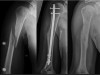 Pathologische Oberarmfraktur rechts bei B-Zell-Lymphom bei einem 37-jährigen Patienten. Die Versorgung erfolgte mittels Marknagelung, postoperativ sofort gegebene regelhafte Funktion des Schulter- und Ellenbogengelenkes. Nach der Metallentfernung Nachweis einer achsengerechte Stellung.