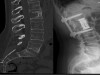 Persistente Metastase eines Lungentumors nach erfolgter Strahlentherapie im Bereich des 2. Lendenwirbelkörpers. Bei Stabilitätsgefährdung erfolgte die operative Stabilisierung mittels Wirbelkörperersatz und Fixateur intern. Erfolgreiche Mobilisation bereits am 1. postoperativen Tag.