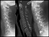 Metastase eines Mammakarzinoms im Bereich des 7. Halswirbelkörpers. Die Stabilisierung erfolgte durch das minimalinvasive Einbringen von Knochenzement (sogenannte Vertebroplastie).