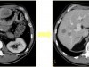 Lebermetastasen vor (links) und nach (rechts) neoadjuvanter Chemotherapie. Nachfolgende Entfernung durch Operation. 